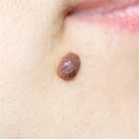 show me a picture of a mole|Types of Moles with Pictures, Causes, and Treatments